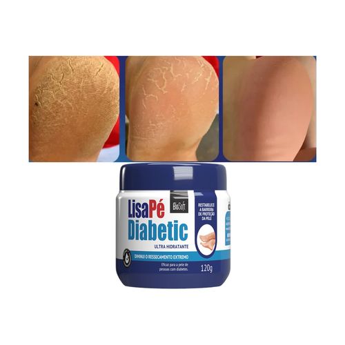 Produto Hidratante Pés Diabéticos Ressecados Com Rachaduras Produto Hidratante Pés Diabéticos Ressecados Com Rachaduras