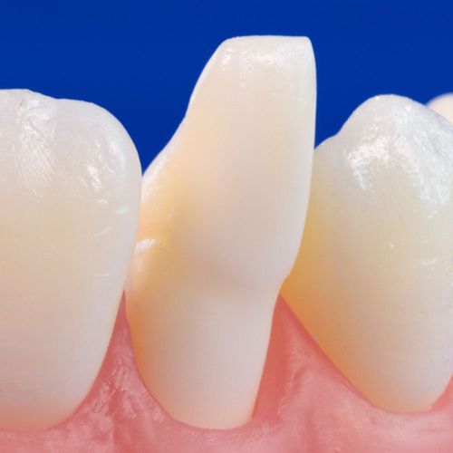 Dente Diferenciado 12.3 Conoide Prodens
